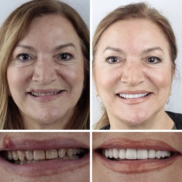 🔥Ends Today: 70% OFF!(Affordable Beauty🧏♀️🧏♂️) --Advanced Customized Full Denture Set🦷