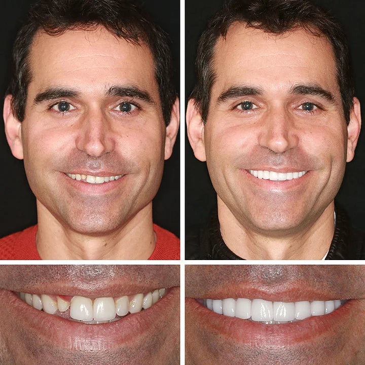 🔥Ends Today: 70% OFF!(Affordable Beauty🧏‍♀️🧏‍♂️) --Advanced Customized Full Denture Set🦷