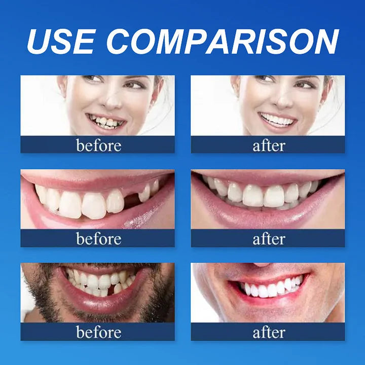 🔥Ends Today: 70% OFF!(Affordable Beauty🧏‍♀️🧏‍♂️) --Advanced Customized Full Denture Set🦷