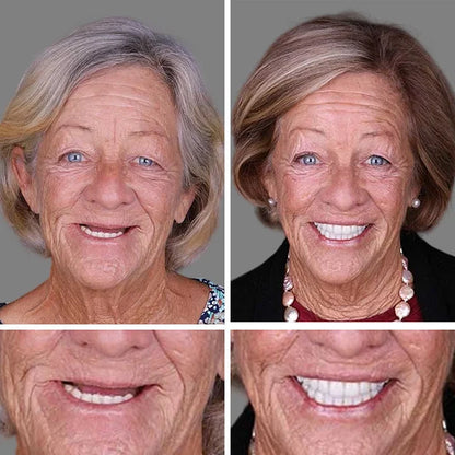 🔥Ends Today: 70% OFF!(Affordable Beauty🧏‍♀️🧏‍♂️) --Advanced Customized Full Denture Set🦷