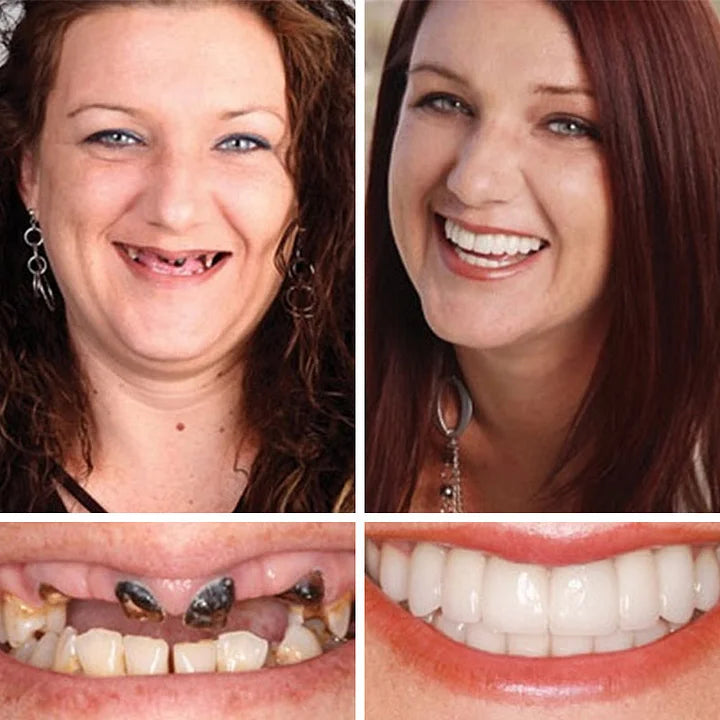 🔥Ends Today: 70% OFF!(Affordable Beauty🧏‍♀️🧏‍♂️) --Advanced Customized Full Denture Set🦷