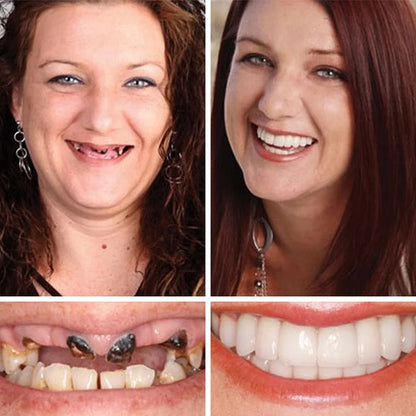🔥Ends Today: 70% OFF!(Affordable Beauty🧏‍♀️🧏‍♂️) --Advanced Customized Full Denture Set🦷
